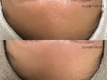 レイル(REIR)/メニュー:純粋レチノールピール