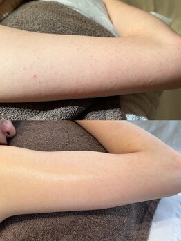 インテリウス(INteRius.)/二の腕ケア