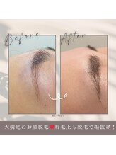 モアトゥインクル 山口店(MORE twinkle)/★症例写真★【20代】