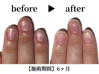 リング ザ ベル(ring the bell)/深爪スタンダードコース¥11,000