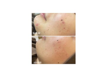 ニコリ(Nicori)/ハーブピーリング