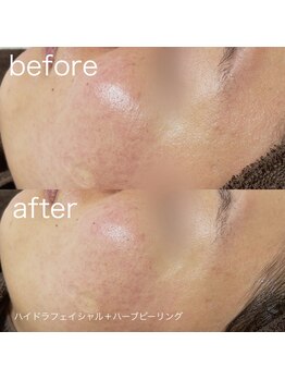 ルルラ リコ(lulula rico)/症例写真/ハーブピーリング