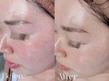 肌質改善サロン