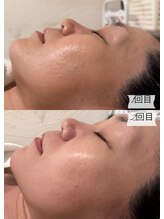 エステサロン アンジュール(Angelle)/1回目→2回目
