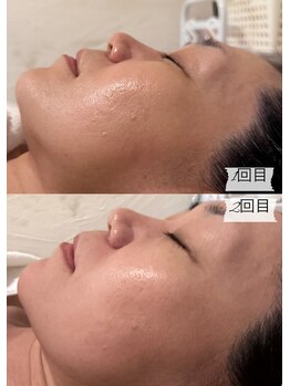 エステサロン アンジュール(Angelle)/1回目→2回目