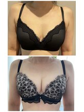 ビービリア(B.villea)/バストアップ施術5回