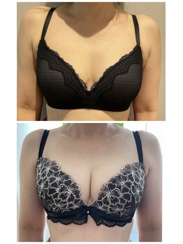 ビービリア(B.villea)/バストアップ施術5回