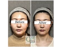 キュープ 相模原淵野辺店(Qpu)/たった4回で人生で1番小さな顔に