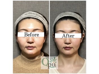 キュープ 相模原淵野辺店(Qpu)/たった4回で人生で1番小さな顔に