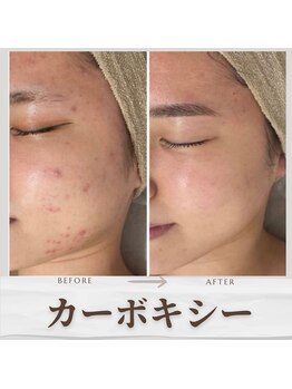 キレナル(KIRENAL)/カーボキシー炭酸パック