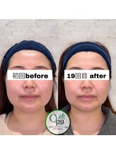 キュープ 相模原淵野辺店(Qpu)/たった4回で人生で1番小さな顔に