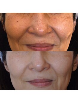 トラット エステアンドアイズ(tratto)/50代お客様症例写真