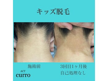 アクト クロ(ACT curro)/【キッズ脱毛】施術例