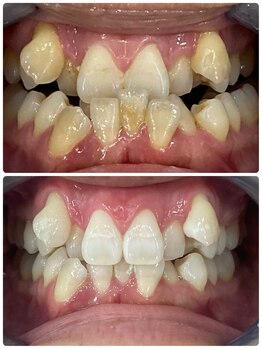 ホワイトニングスタイル 柏店/Before After