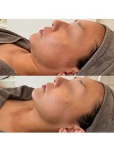 グレーシス(Graces)/韓国で大注目！チタニウムリフト