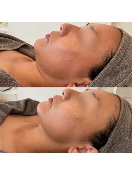 グレーシス(Graces)/韓国で大注目！チタニウムリフト