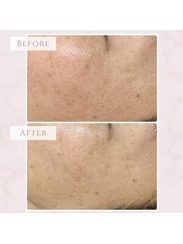 ベベ 福井丸岡店(Be'be')/オーヴル毛穴プレミアム