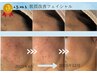 【平日11時～15時限定】5500円★ゆらぎ・赤み・ニキビ肌改善フェイシャル60分