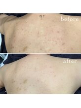 ビースキン(B SKIN)/背中ケア