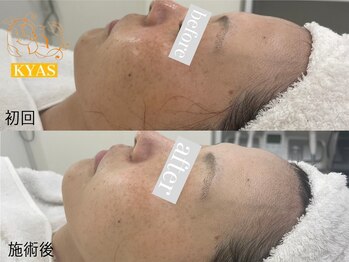 キャス(KYAS)/[ハーブピーリング]エイジング