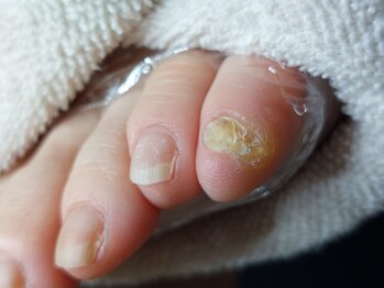 爪切り屋 足楽/爪？→魚の目です　【before】