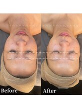 アンバー(amber)/ハーブピーリング and 小顔矯正