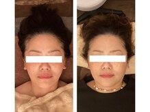 ビーチェ(BICE)/ホワイトハーブピーリング4回目