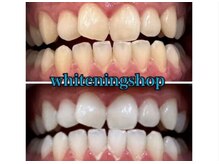 ホワイトニングショップ 京都駅前店/40分×10回Before/Afte