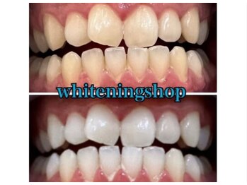 ホワイトニングショップ 京都駅前店/40分×10回Before/Afte