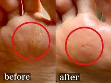 しあん 京都/タコ（胼胝）に悩む！