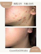 クオーレ ハギワラ(cuore HAGIWARA)/肌質改善/ニキビ・赤み・敏感
