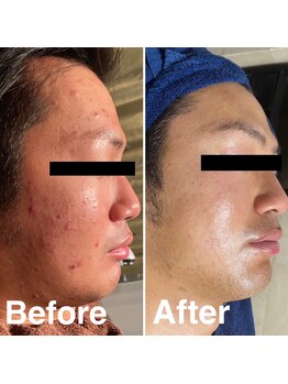 クイーン 熱海店(Queen)/長年のニキビ肌は徹底ケア