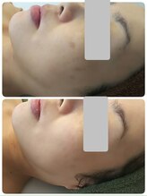 デイスパ コオリナ(DAYSPA Ko olina)/シミケア◎毛穴レス肌◎