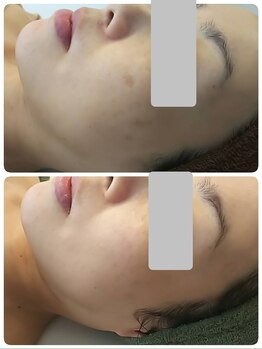 デイスパ コオリナ(DAYSPA Ko olina)/シミケア◎毛穴レス肌◎