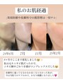 ソナ 大和西大寺院(SONA)&nbsp;元、エラ張り・ニキビ肌。サロンケアでここまで変わる！