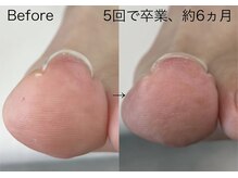 ロンディネ(Rondine)/巻き爪ケア/ネイルトリム10