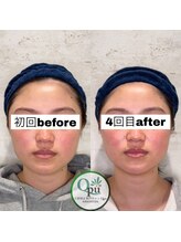 キュープ 相模原淵野辺店(Qpu)/たった4回で人生で1番小さな顔に