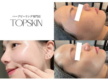トップスキン 渋谷(TOPSKIN)の写真/【当店独占導入*最新肌育ハーブピーリング】ピンとハリ感！潤ツヤの水光肌へ◎夏のダメージ肌も徹底改善☆
