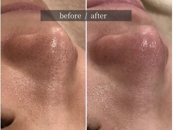 ブリリオ 池袋店(Brillio)/ハイドラ毛穴洗浄/一回での効果