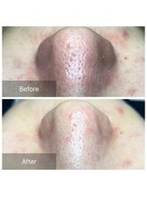 ダブル(W)/毛穴エクストラクションtete式