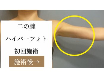 肌音色/■二の腕ハイパーフォト 40代~