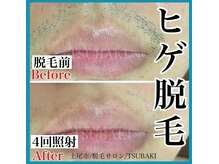 ツバキ(TSUBAKI)/ヒゲ脱毛