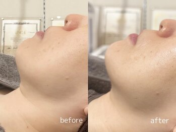 パールフェイスエステ ルペルル(PEARL FACE ESTHE la perle)/タルミ改善