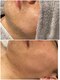 ケードット カシェットプラス(K.CACHETTE+)の写真/【清潔感UPで好感度も急上昇◎】ひげ脱毛専用モード搭載!最新機器の光脱毛で痛みほぼ０（ゼロ）の快適脱毛!
