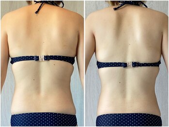 インプルーブ 浜北店(Improve)/4ヶ月で姿勢も改善　30代女性