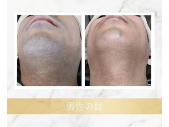 アンド エヌ(&n)/◆髭脱毛◆