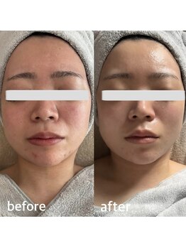 アリア(allia)/赤み、肌荒れ