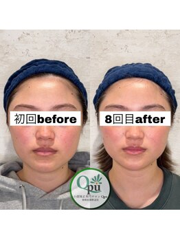 キュープ 相模原淵野辺店(Qpu)/たった4回で人生で1番小さな顔に