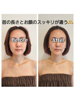 ザヨン(Zayon)の写真/【内側から整える小顔印象×ヘッドスパ】上向きリフトケア好評◎むくみ・首肩の重だるさもスッキリ♪