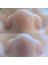 アネモネ(ANEMONE)/韓国式3D毛穴洗浄